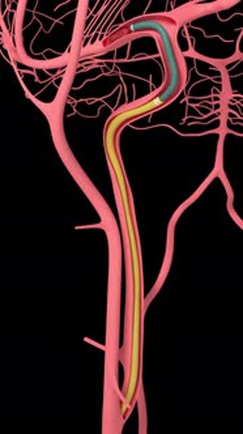 Brain Clot Removal Vertical Video