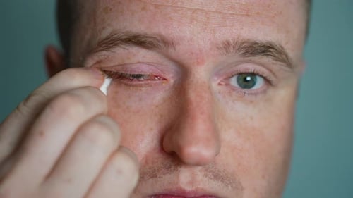 Man Applying Ointment to Infected Eye