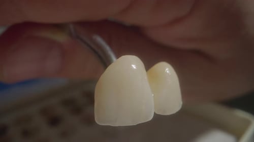 Prosthodontist Carefully Positions Porcelain Crown Accurately