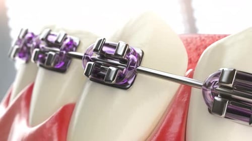 Primer plano de un modelo de dientes humanos con aparatos dentales, tratamiento de ortodoncia y cuidado dental