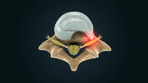 Spinal Disc Herniation Relief and Nerve Decompression 3D Animation
