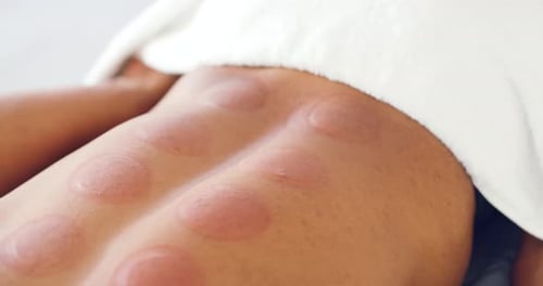 A male client with red back bruises after getting a cupping massage at a wellness spa