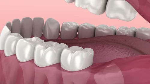 Dental Molar Extraction and Implant Placement 3D Animation