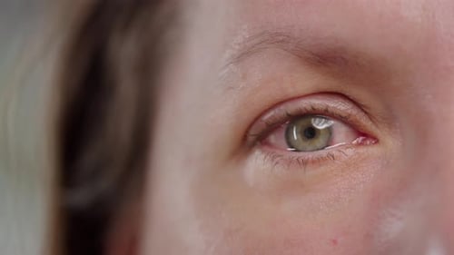 Red Blood Eye of Woman Affected By Conjunctivitis or After Flu Cold or Allergy