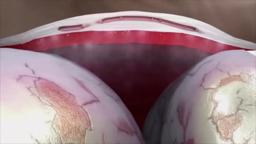 Pannus Growth on Human Eye Medical Animation