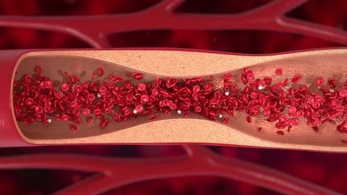 Blood Stream in Veins Affected by Cholesterol