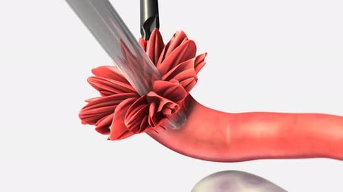 Medical Device Implanting Particles into Organ Tissue
