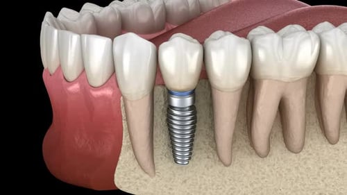 Dental Implant Installation in Jawbone with Cross Section Animation