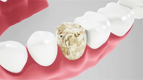 3D Illustration of Tooth Decay Among Healthy Teeth