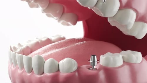 3D Animation of Dental Implant Installation and Structure