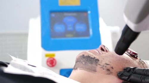 Carbon Peel Laser Treatment in a Medical Setting