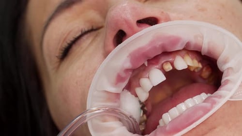 Dentist Placing Veneer on Patient's Teeth Close Up