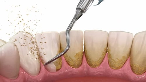 Oral hygiene: Teeth Cleaning Ultrasonic Scaling (conventional periodontal therapy).
