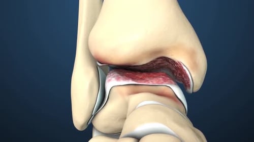 Ankle Joint Bone Spurs Formation Medical 3D Animation