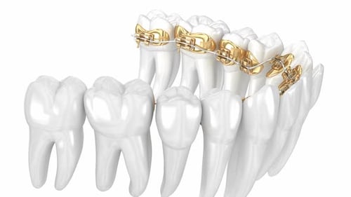 Sistema de ortodoncia dorada lingual. Animación dental 3D