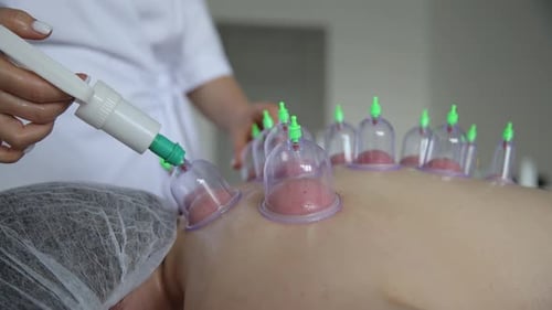 Woman Receives Cupping Therapy Treatment for Back Pain