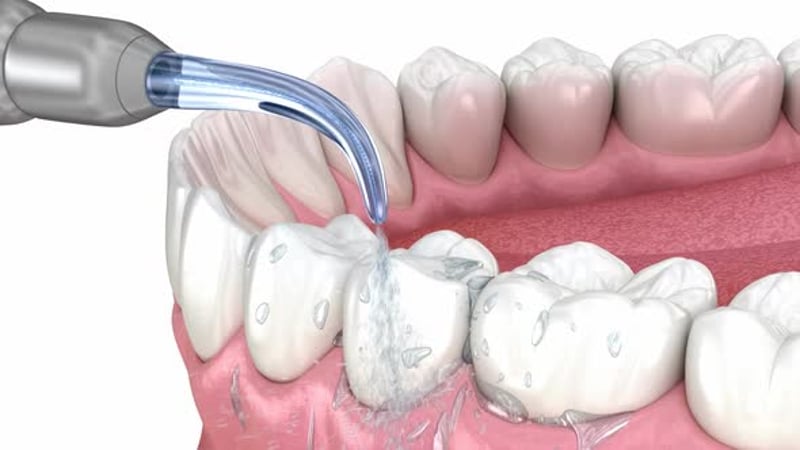 Oral hygiene: Ultrasonic teeth cleaning machine removing calculus and ...