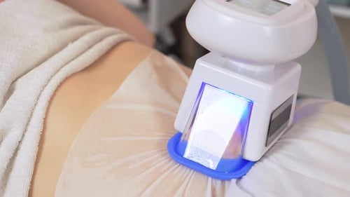 Nahaufnahme des maschinellen Kryolipolyse-Fettbehandlungsverfahrens einer Anti-Cellulite-Hardware für junge Frauen