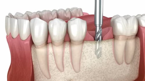 3D Animated Dental Implant Procedure on Jawbone