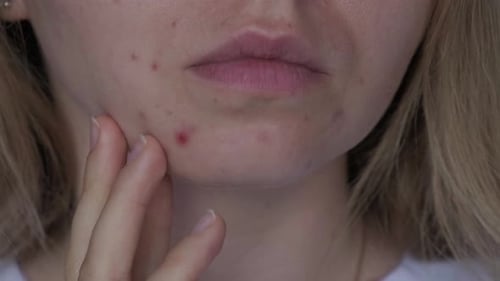 Unrecognizable Woman Showing Her Acne on Face