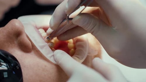 Un dentista bucal de cerca con herramientas especiales coloca aparatos ortopédicos en el ortodoncista puliendo