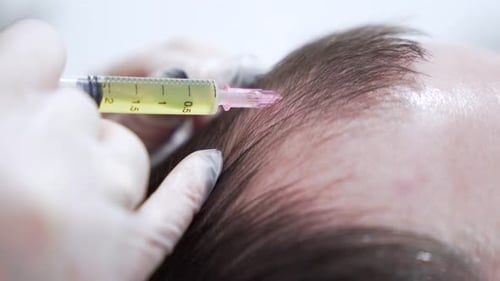 Macro Shot of Hair Mesotherapy Procedure in the Modern Cosmetology Clinic Plasma Injectiions Middle