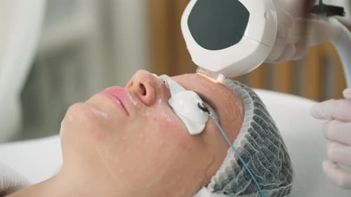 Woman Receives Laser Skincare Treatment on Forehead