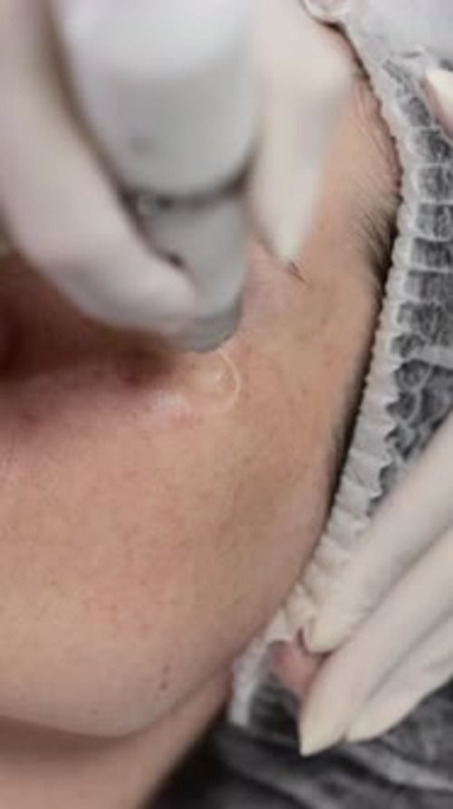 Noninjection Mesotherapy