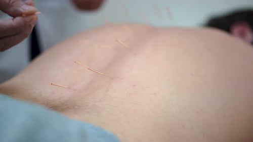 Akupunkteur platziert Nadeln auf den Rücken des Patienten zur Schmerzlinderung