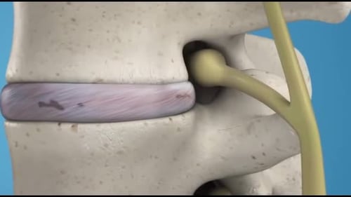 Lumbar Disc Herniation Compressing Nerve Medical Animation