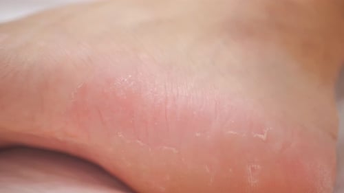 Cracked Heel Close Up Foot Health