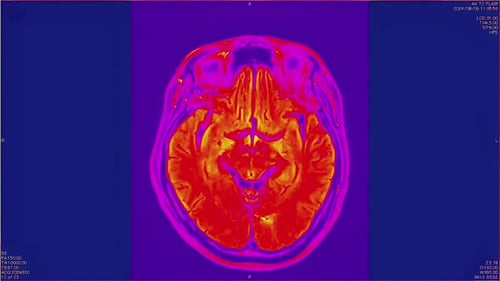 Magnetic Resonance Images of the Brain MRI of the Brain of a Patient with Multiple Vascular