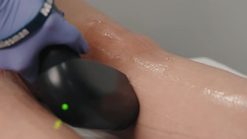 Woman Receiving Laser Hair Removal Treatment on Legs