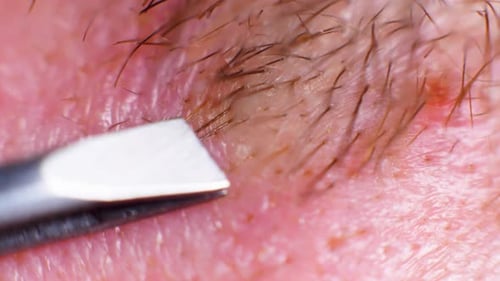 4K Super macro shot of hair removal with tweezers, on a caucasian person, at an extreme close up, in