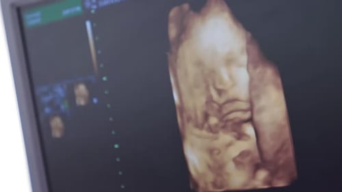 Ultrasound of Unborn Baby Displayed on Monitor