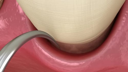 Laser hardening the blood. Medically accurate tooth 3D animation of dental treatment