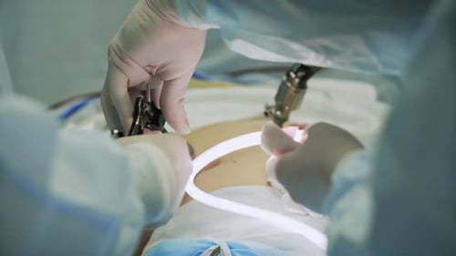 Surgeons Team Preforming Operation in Hospital Operating Theater Surgeon Operating Patientwearing