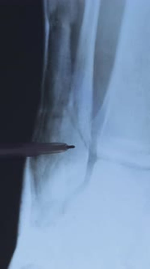 Ankle X-ray Examined with Pen