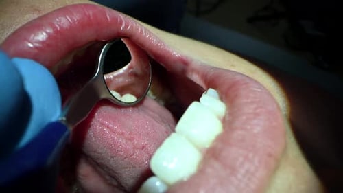 Dental Care Extreme Close Up Macro Video Dentist Treat Patient Teeth Orthodontist Works with