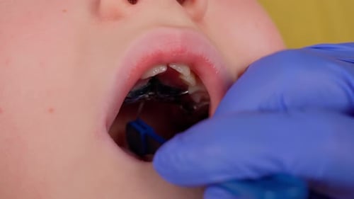 Setup orthodontic plate in child mouth. Palatal expander to straight teeth. Dentist in gloves
