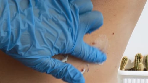 Applying Cream to Moles