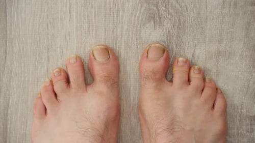 Male Feet with Toenail Fungus Infection