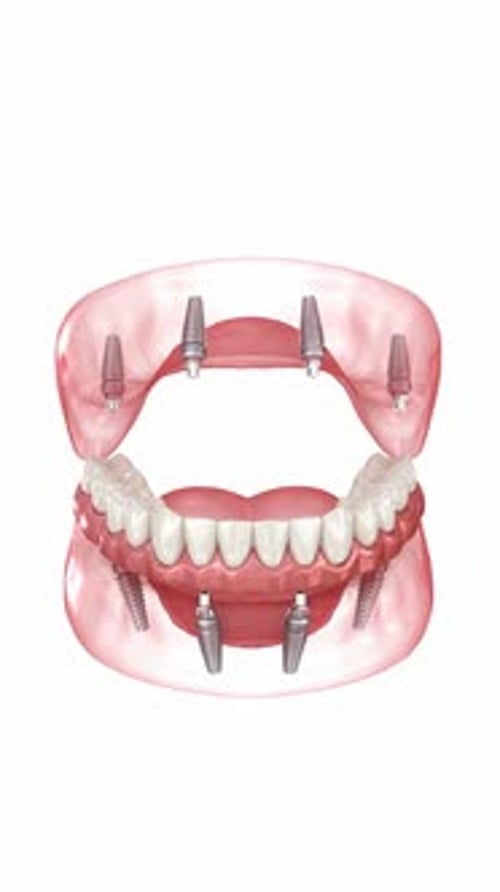 3D Animation of Dental Implants and Teeth Attachment