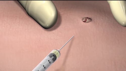 Medical Animation of Skin Lesion Excision with Scalpel and Forceps