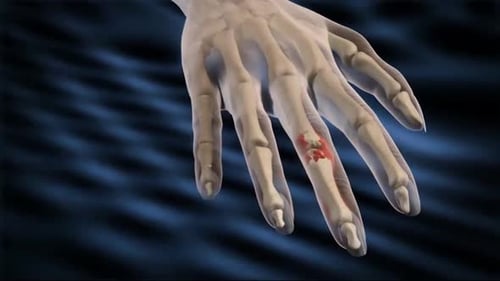 3D Animation of Hand Joint with Arthritis and Inflammation