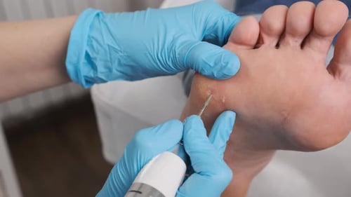 Foot Being Treated with a Grinding Tool