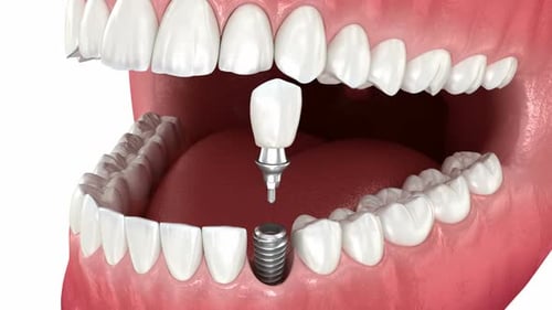 Realistic 3D Dental Implant Installation Animation