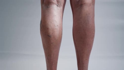 Venas varicosas hinchadas en las piernas femeninas con inflamación dolorosa