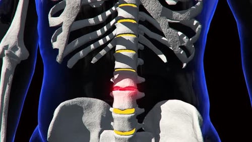 3D Human Lumbar Spine Animation with Intervertebral Disc Injury