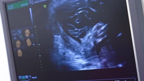 El bebé en el vientre de la madre se mueve durante la ecografía. Pantalla de ultrasonografía.
